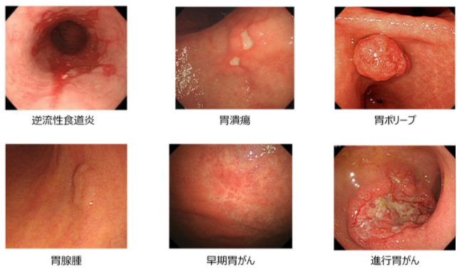 胃透視と胃カメラの違い|どちらの検査を受ければよいのか?